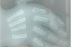vacterl-13-costillas-alteracion-sacro-cardiopatia-atresia-esofagica-agenesia-radio-2003-000
