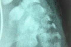 vacterl-13-costillas-alteracion-sacro-cardiopatia-atresia-esofagica-agenesia-radio-2003-003