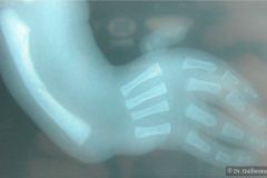 vacterl-13-costillas-alteracion-sacro-cardiopatia-atresia-esofagica-agenesia-radio-2003-005