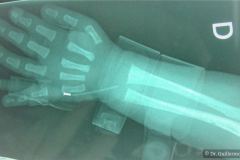 vacterl-13-costillas-alteracion-sacro-cardiopatia-atresia-esofagica-agenesia-radio-2003-008