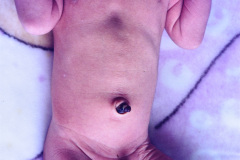 valvula-derivacion-ventriculo-peritoneal-004