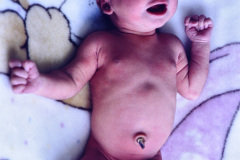 valvula-derivacion-ventriculo-peritoneal-005