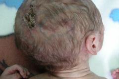 van-lohuizen-cutis-marmorata-telangiectasica-congenita-ulceras-flebectasia-craneal-nevus-hiperpigmentado-4d-1m-2005-025