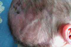 van-lohuizen-cutis-marmorata-telangiectasica-congenita-ulceras-flebectasia-craneal-nevus-hiperpigmentado-4d-1m-2005-027
