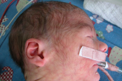 van-lohuizen-cutis-marmorata-telangiectasica-congenita-ulceras-flebectasia-craneal-nevus-hiperpigmentado-4d-1m-2005-028