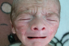 van-lohuizen-cutis-marmorata-telangiectasica-congenita-ulceras-flebectasia-craneal-nevus-hiperpigmentado-4d-1m-2005-029