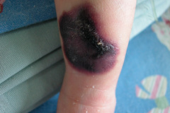 van-lohuizen-cutis-marmorata-telangiectasica-congenita-ulceras-flebectasia-craneal-nevus-hiperpigmentado-4d-1m-2005-030