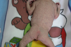 van-lohuizen-cutis-marmorata-telangiectasica-congenita-ulceras-flebectasia-craneal-nevus-hiperpigmentado-4d-1m-2005-031