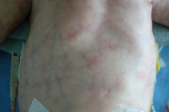 van-lohuizen-cutis-marmorata-telangiectasica-congenita-ulceras-flebectasia-craneal-nevus-hiperpigmentado-4d-1m-2005-033