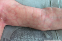 van-lohuizen-cutis-marmorata-telangiectasica-congenita-ulceras-flebectasia-craneal-nevus-hiperpigmentado-4d-1m-2005-034