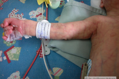 van-lohuizen-cutis-marmorata-telangiectasica-congenita-ulceras-flebectasia-craneal-nevus-hiperpigmentado-4d-1m-2005-035
