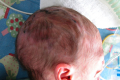 van-lohuizen-cutis-marmorata-telangiectasica-congenita-ulceras-flebectasia-craneal-nevus-hiperpigmentado-4d-1m-2005-038