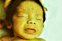 varicela-congenita-coriorretinitis-000
