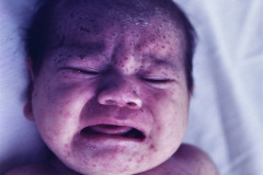 varicela-neonatal-1989-002