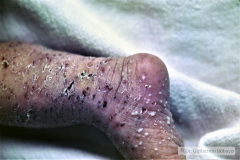 varicela-neonatal-1989-004