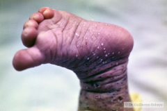 varicela-neonatal-1989-009