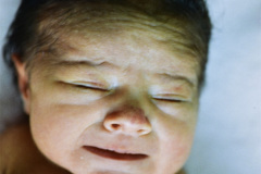 vater-agenesia-cubito-radio-izq-mar-colostomia-1988-003