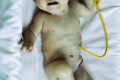 vater-atresia-esofago-esofagostomia-gastrostomia-mar-colostomia-6m-1989-004