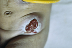 vater-atresia-esofago-esofagostomia-gastrostomia-mar-colostomia-6m-1989-007