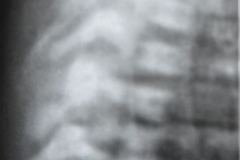 vater-atresia-esofago-fistula-traqueoesofagica-fusion-costal-hemivertebra-1985-000