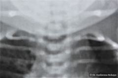 vater-atresia-esofago-fistula-traqueoesofagica-fusion-costal-hemivertebra-1985-001