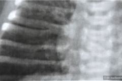 vater-atresia-esofago-fistula-traqueoesofagica-fusion-costal-hemivertebra-1985-003