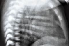 vater-atresia-esofago-fistula-traqueoesofagica-fusion-costal-hemivertebra-1985-004