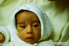 vater-atresia-esofago-fistula-traqueoesofagica-mar-fistula-rectovesical-1987-005
