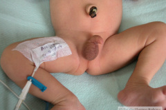 vater-atresia-esofago-fisutla-traqueoesofagica-anomalias-extremidades-2004-000