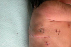 vater-atresia-esofago-fisutla-traqueoesofagica-anomalias-extremidades-2004-007