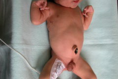 vater-atresia-esofago-fisutla-traqueoesofagica-anomalias-extremidades-2004-009