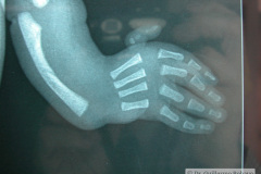 vater-vertebra-anal-anomalia-traqueo-esofagico-anomalia-renal-anomalia-13d-2003-007