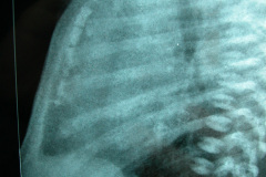 vater-vertebra-anal-anomalia-traqueo-esofagico-anomalia-renal-anomalia-13d-2003-010