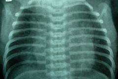 vater-vertebra-anal-anomalia-traqueo-esofagico-anomalia-renal-anomalia-13d-2003-011