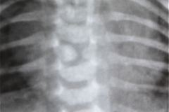 vertebra-en-mariposa-raquisquisis-cardiomegalia-1998-000