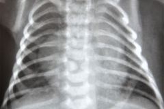 vertebra-en-mariposa-raquisquisis-cardiomegalia-1998-001