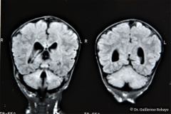 werdnig-hoffman-atrofia-muscular-espinal-proximal-tipo-1-higroma-subdural-1994-000