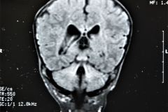 werdnig-hoffman-atrofia-muscular-espinal-proximal-tipo-1-higroma-subdural-1994-003