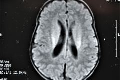 werdnig-hoffman-atrofia-muscular-espinal-proximal-tipo-1-higroma-subdural-1994-005
