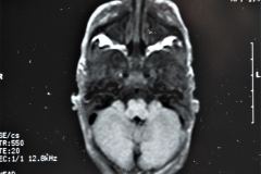 werdnig-hoffman-atrofia-muscular-espinal-proximal-tipo-1-higroma-subdural-1994-006