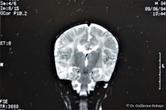 werdnig-hoffman-atrofia-muscular-espinal-proximal-tipo-1-higroma-subdural-1994-013