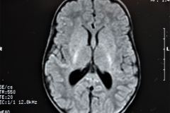 werdnig-hoffman-atrofia-muscular-espinal-proximal-tipo-1-higroma-subdural-1994-014