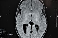 werdnig-hoffman-atrofia-muscular-espinal-proximal-tipo-1-higroma-subdural-1994-018
