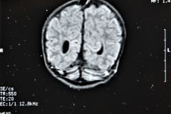werdnig-hoffman-atrofia-muscular-espinal-proximal-tipo-1-higroma-subdural-1994-022