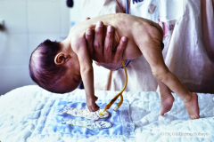werdnig-hoffmann-atrofia-muscular-espinal-proximal-tipo-1-hipotonia-general-no-susccion-ni-deglusion-gastrostomia-1994-002