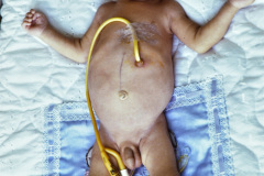 werdnig-hoffmann-atrofia-muscular-espinal-proximal-tipo-1-hipotonia-general-no-susccion-ni-deglusion-gastrostomia-1994-004