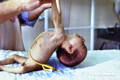 werdnig-hoffmann-atrofia-muscular-espinal-proximal-tipo-1-hipotonia-general-no-susccion-ni-deglusion-gastrostomia-1994-005