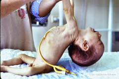 werdnig-hoffmann-atrofia-muscular-espinal-proximal-tipo-1-hipotonia-general-no-susccion-ni-deglusion-gastrostomia-1994-006