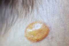 xantogranuloma-juvenil-1988-003
