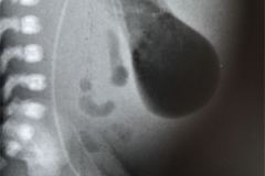 yelco-arterial-femoral-izq-cateter-venoso-femoral-der-gastroparesia-1996-000